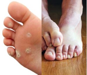 Fungal Infection - Toenail कवक, जिसे onychomycosis के रूप में भी जाना जाता है, आपके toenails का एक सामान्य कवक संक्रमण है। सबसे अधिक ध्यान देने योग्य लक्षण आपके एक या अधिक पैर के नाखूनों का सफेद, भूरा या पीला रंग है।